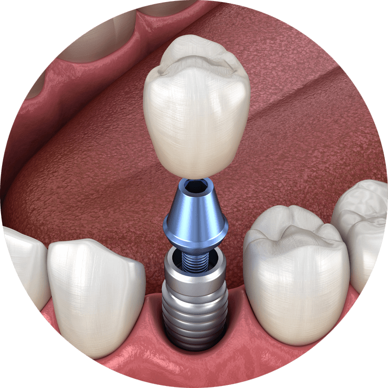 dental implants