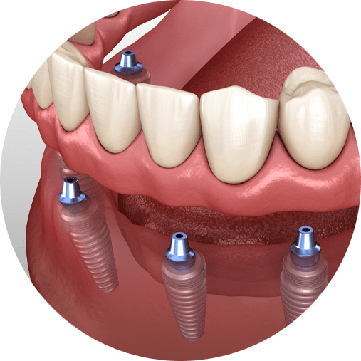 Revealing the Cost of Full Mouth Dental Implants in Jacksonville, FL