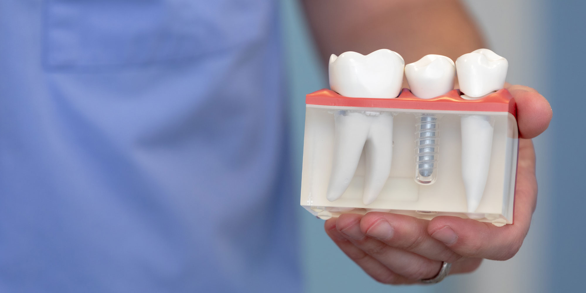 dental implants.