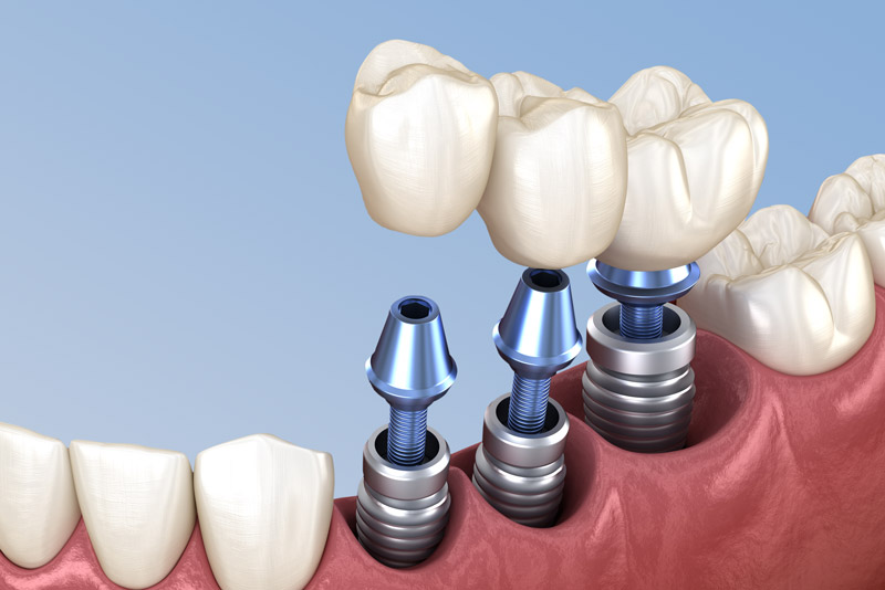 Eager To Learn About The Parts That Compose A Dental Implant In Jacksonville, FL? We Can Tell You All About Them