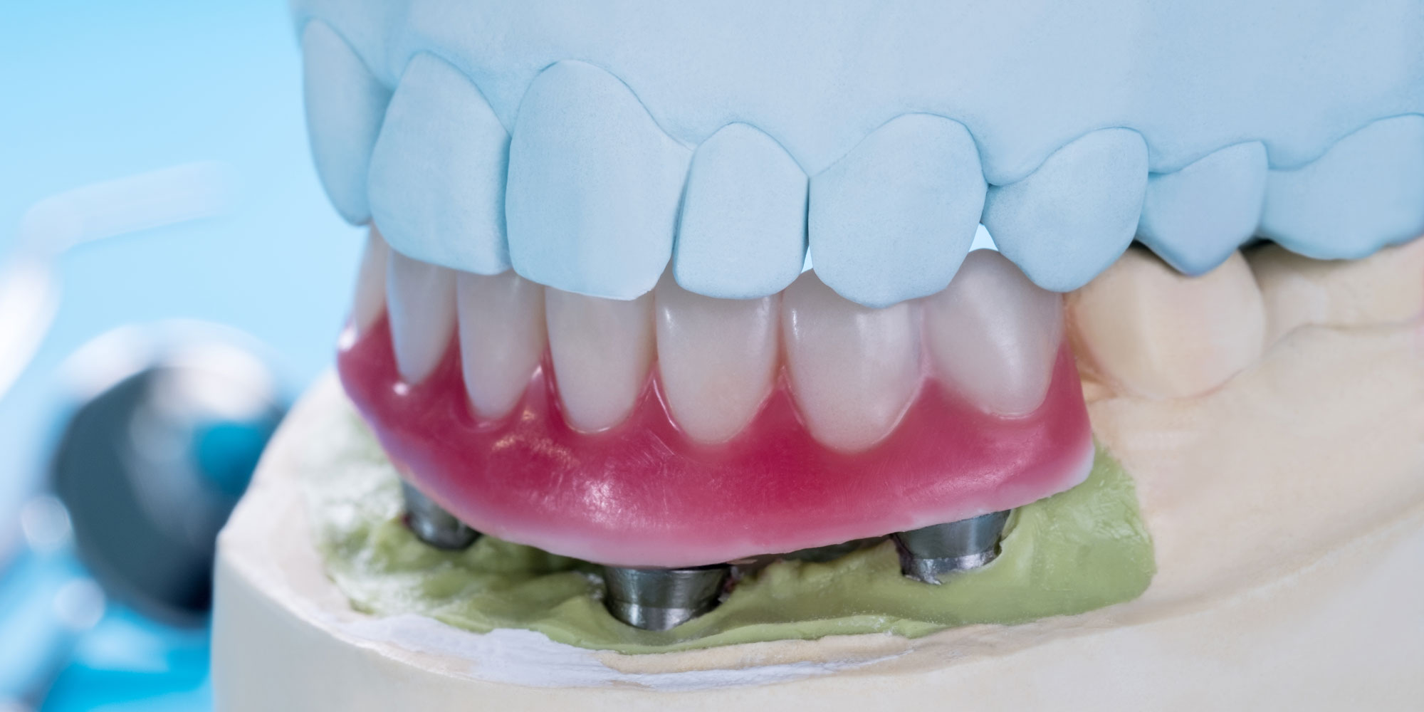 The Benefits, Procedure, and Aftercare of Denture Implants in Jacksonville, FL