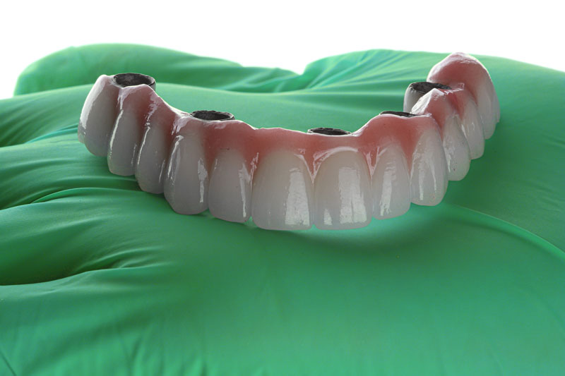 Enhancing Smiles in Springfield: A Comprehensive Guide to Dental Implants