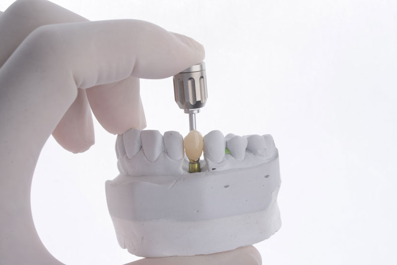 Unveiling the Secret to a New Smile: All on 4 Dental Implants in Hyde Park