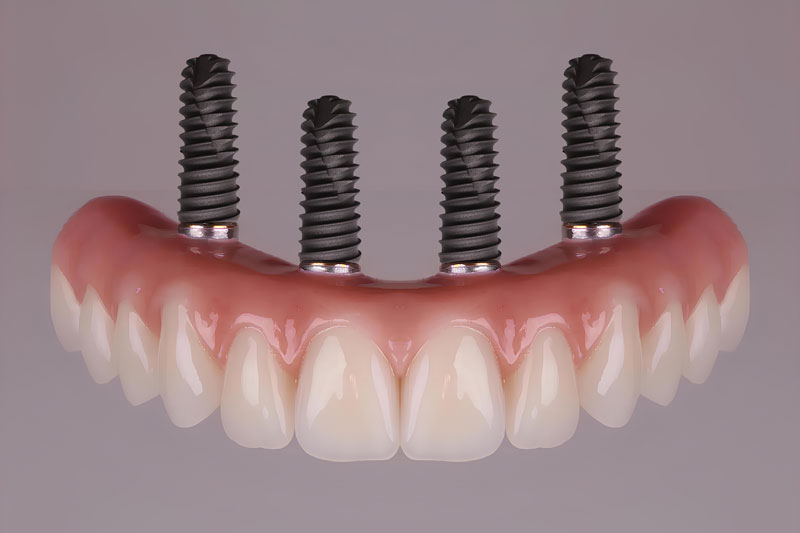 Rediscovering Smile Confidence with Dental Implants in Hyde Park