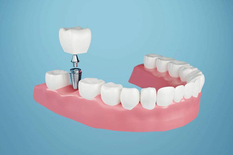  Affordable Dental Implant Contractors  in Jacksonville, Florida thumbnail