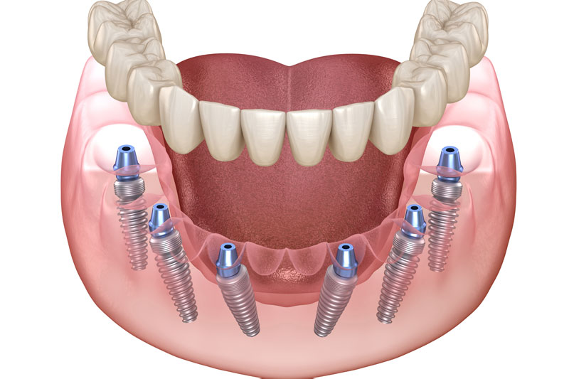 Transforming Smiles with Full Mouth Dental Implants in Jacksonville, FL