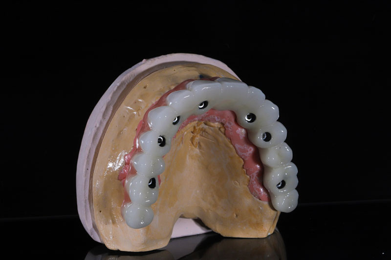 All On 4 Dental Implants: Transforming Smiles in San Marco, FL