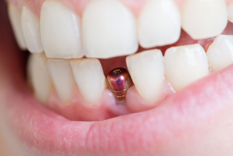 The Comprehensive Guide to Full Mouth Dental Implants in Hyde Park