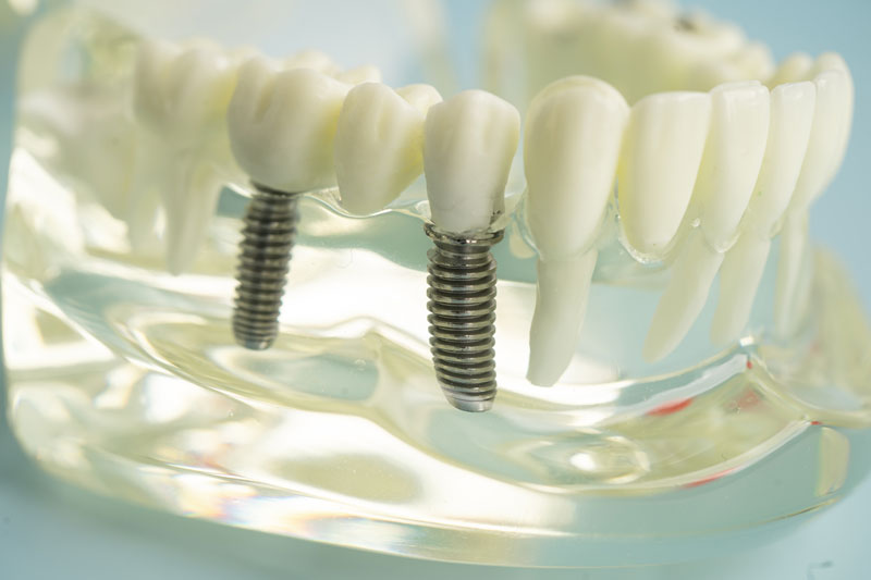 2 single dental implants placed into a clear jaw model with crowns on top