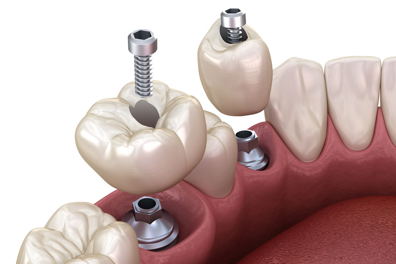 2 single dental implants with a crown on top of the abutment